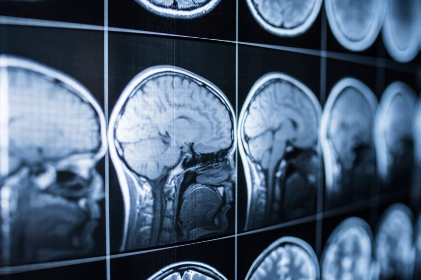 The Most Common Brain Injuries From Medical Malpractice